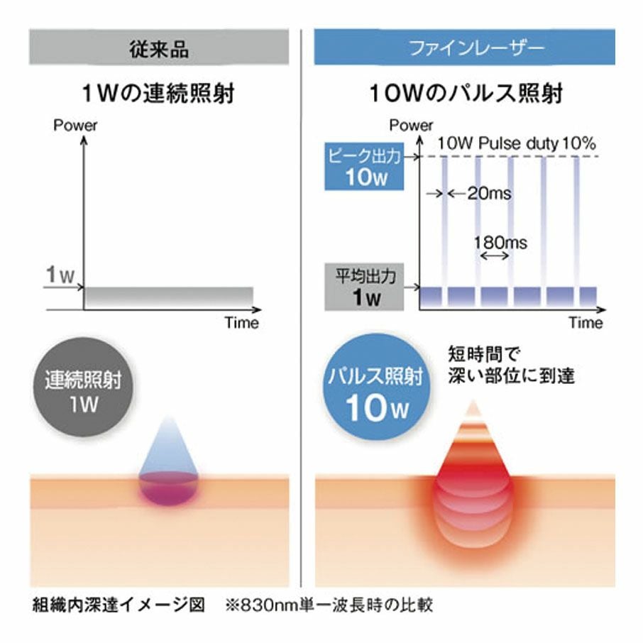 ファインレーザーEL-1000 解説